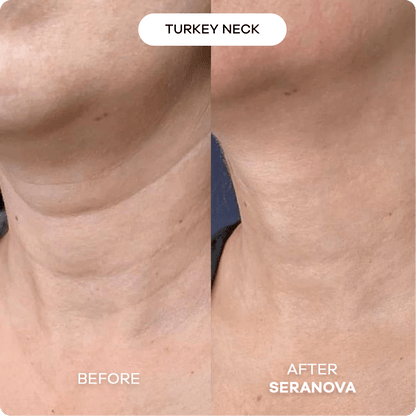 Appareil d’Infusion Cutanée Kyeoo™